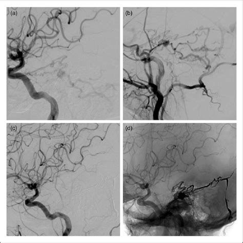 Case Patient A Left Internal Carotid Artery Ica Angiogram