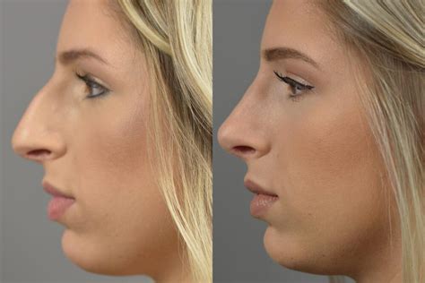 Nose Surgery Before After Patient 08 Dr Marotta