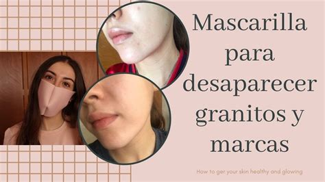 Mascarilla Para Quitar Marcas Y Granitos Youtube