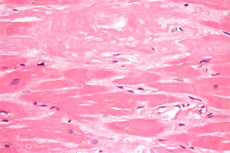 Amyloid Cardiomyopathy