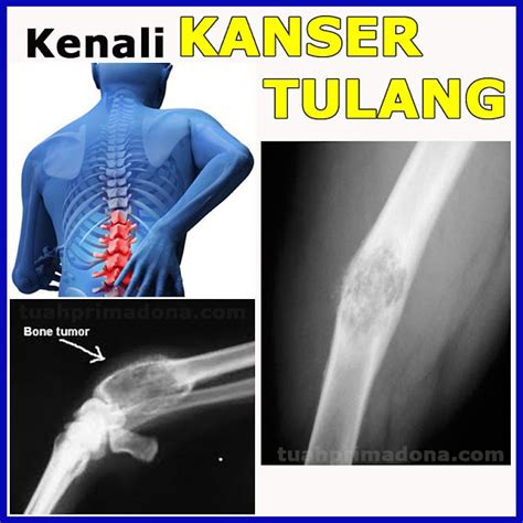 Kanser Tulang Bone Cancer Masihkah Ada Peluang One Stop Cancer