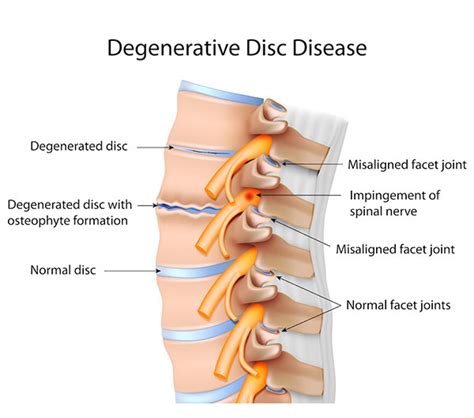 Low Back Pain | Facet Joint Syndrome | Facet Lock