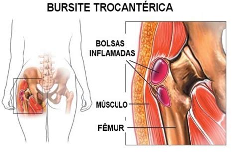 Trocanteritis causas síntomas y tratamiento para aliviar el dolor en