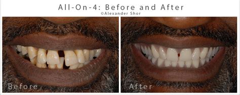 All On 4 Dental Implants Before And After Seattle Shor Dental