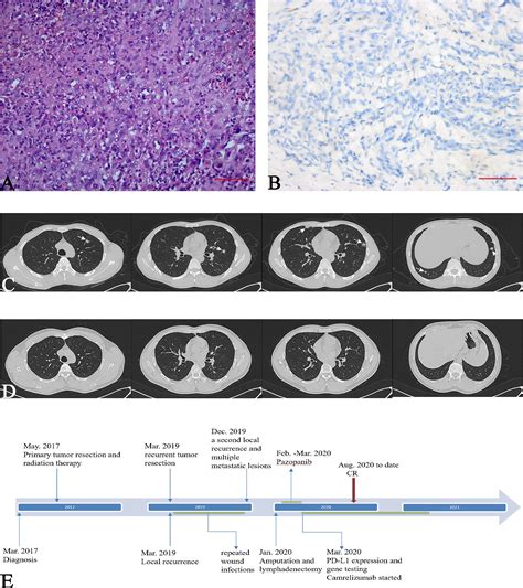 Frontiers Case Report Pulmonary Metastases From Epithelioid Sarcoma