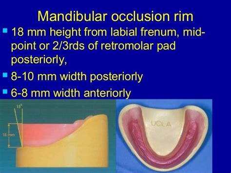 Record Bases And Occlusal Rims