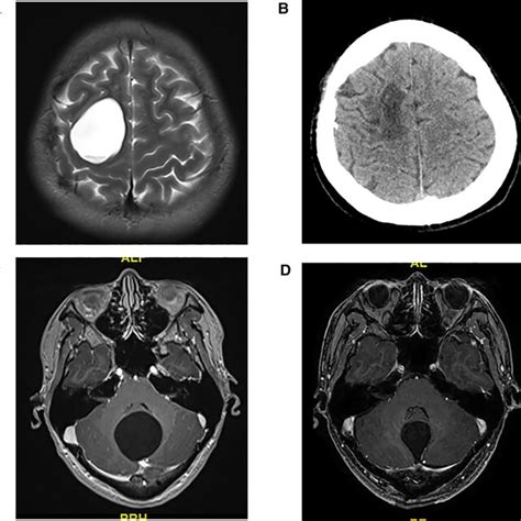 A Preoperative T2 MRI Image Of No 13 Patient B Preoperative CT