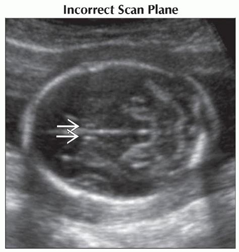 Absent Cavum Septi Pellucidi Obgyn Key