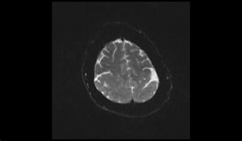 Pachygyria MRI | Radiology Article on Oligodendroglioma