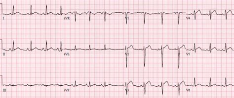 Early Repolarization Or Anterior Stemi Ecg Cases Em Cases