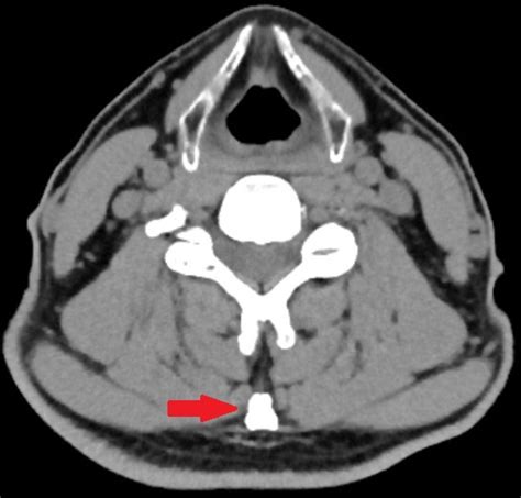 Ossification Of The Nuchal Ligament Bmj Case Reports