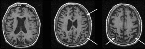 MRI of a patient with a pathological diagnosis of Parkinsonism ...