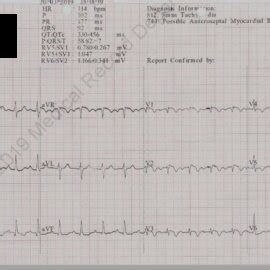 ECG Showed Sinus Tachycardia S1 QIII TIII Right Axis Deviation