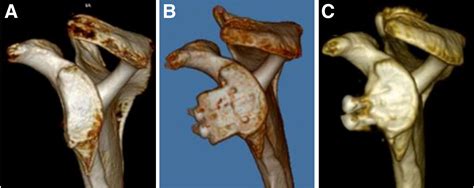 All Arthroscopic Glenoid Bone Augmentation Using Iliac Crest Autograft Procedure For Recurrent