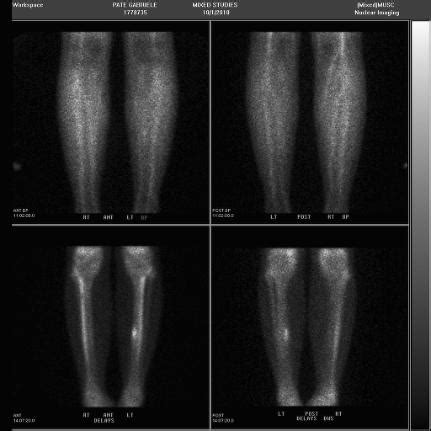 Femoral Neck Stress Fracture Mri