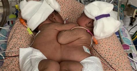 Conjoined Twins Separated By Texas Doctors After Historic Hour