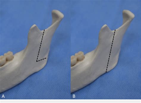 Lateral View Of The Osteotomy Line A L Shaped Intraoral Download Scientific Diagram