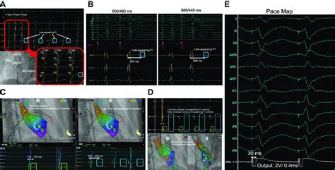 A Intracardiac Electrogram And Fluoroscopic Image At The Moment Of The