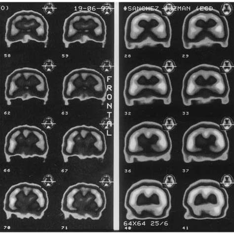 Spect Images Of The Brain Coronal Slices Marked With Tc M Ecd In The