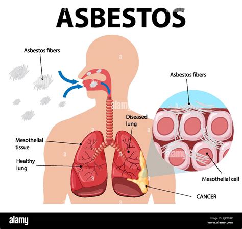 Diagram Showing Asbestosis In Lungs Illustration Stock Vector Image