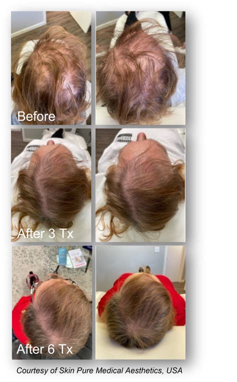 Keralase Hair Restoration Treatment A Breakthrough Therapy For