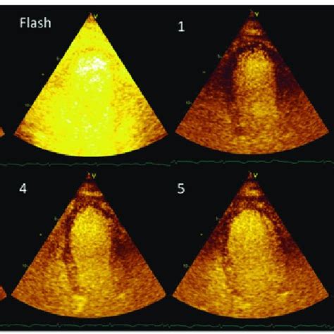 Pdf Bedside Myocardial Perfusion Assessment With Contrast