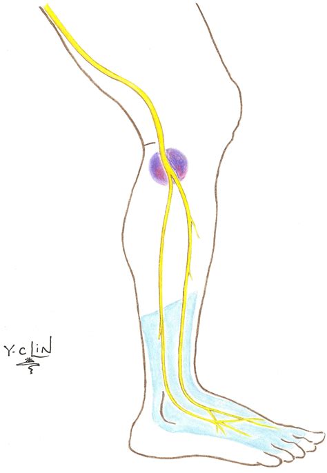 Conditions and Treatments | Brachial Plexus Program | Michigan Medicine ...