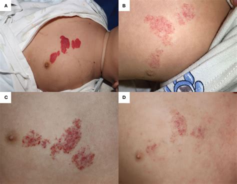 Frontiers Case Report Deterioration Of Infantile Hemangioma Related