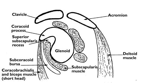 Subcoracoid Bursitis