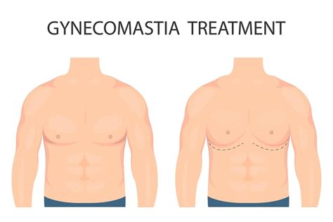 Expert Gynecomastia Treatment At Meadows Wellness