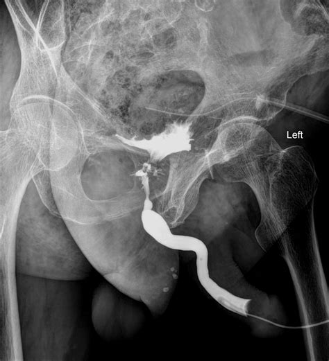 Urethral Stricture Image Radiopaedia Org