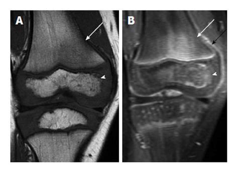 Osteomyelitis Mri Foot