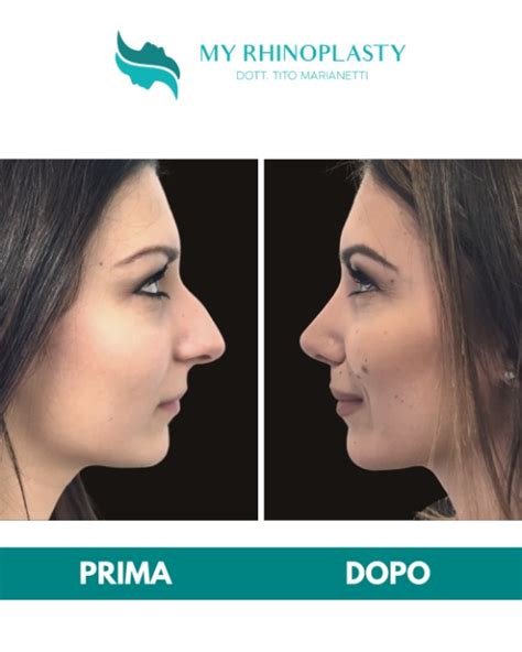 Rinoplastica My Rhinoplasty