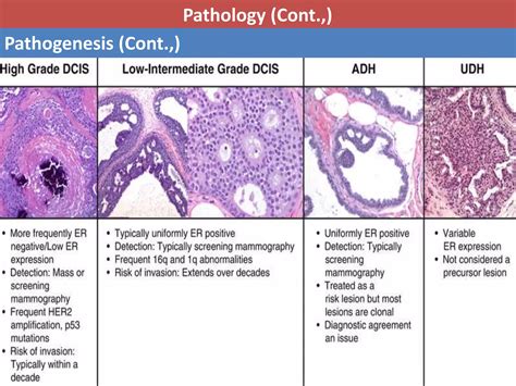 Ductal Carcinoma In Situ Dcis Ppt