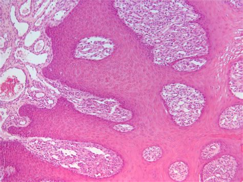 Oral Fibropapillomatosis And Epidermal Hyperplasia Of The Lip In