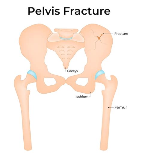 Fractura De La Pelvis Fractura Del C Ccix Del Isquium Del F Mur