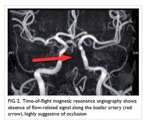 Basilar Artery Mri