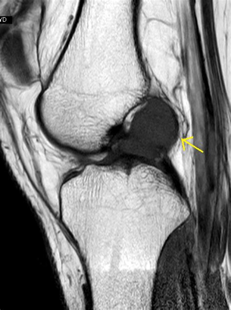 Ganglion Cyst of ACL-MRI - Sumer's Radiology Blog