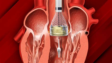 Tavi Procedure A Boon For Critical Heart Patients During The Pandemic