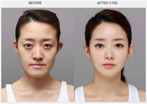 Before and After Photos of Korean Plastic Surgery (30 PICS) - Izismile.com