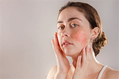 Identifying Mild Rosacea And Seeking Treatment Sl Aesthetic Clinic