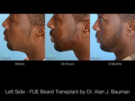 Fue Beard Transplant For African American Patient