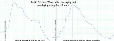 (a and b) Aortic pressure wave forms derived from the surface of chest ...