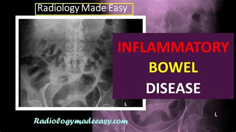 Inflammatory Bowel Disease Radiological Interpretation For Doctors