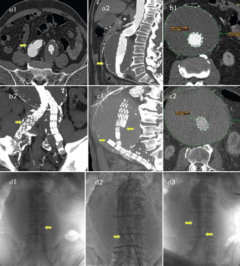 Case Report Of Type Iiia Endoleak After Endovascular Aortic