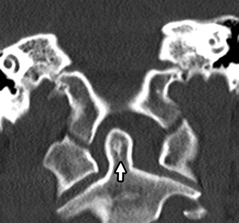 Imaging Of Atlanto Occipital And Atlantoaxial Traumatic Injuries What