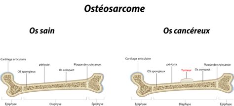 Comment traiter le cancer des os Information hospitalière Lexique