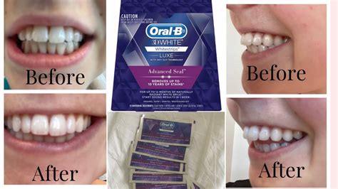 Teeth Whitening Strips Before And After