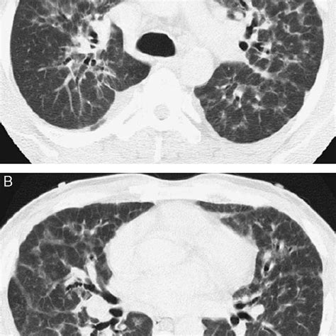 Photomicrograph Of Transbronchial Lung Biopsy Specimen Demonstrates