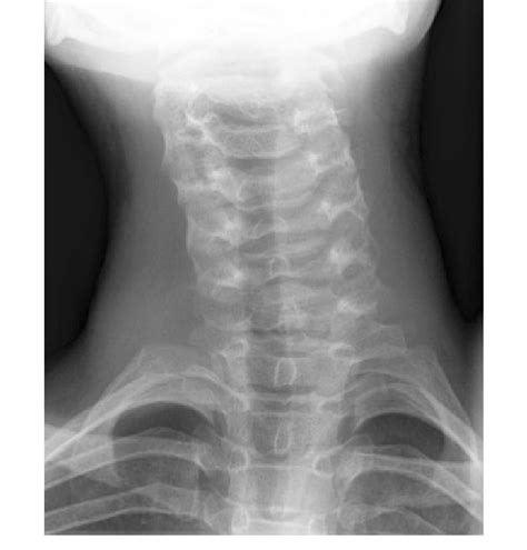 Preoperative Anteroposterior X Ray Download Scientific Diagram